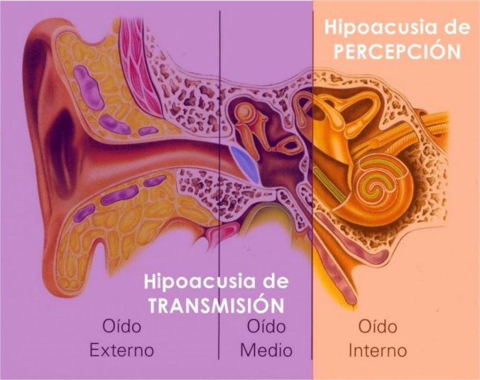 La Sordera De Percepción Síntomas Y Causas Blog De Kiversal