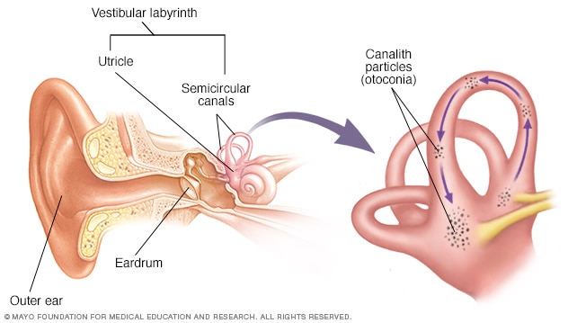 In cases of BPPV, or Benign Paroxysmal Positional Vertigo, small calcium crystals (canalith particles or otoconia) migrate into the fluid. 