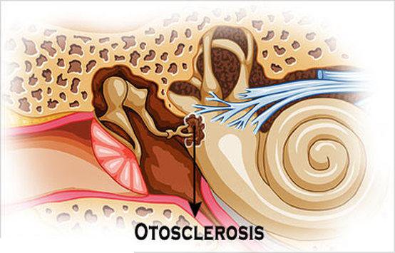 otosclerosis otoscopy